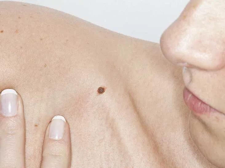 Crusty Moles