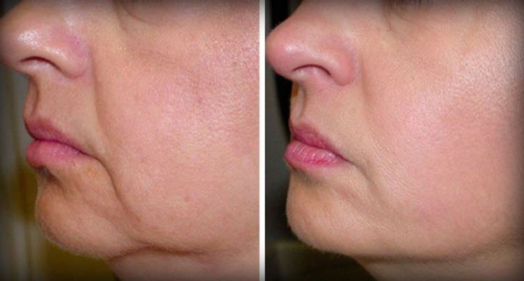 Before and after - loose skin on face