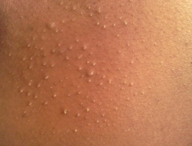 Whiteheads on arms