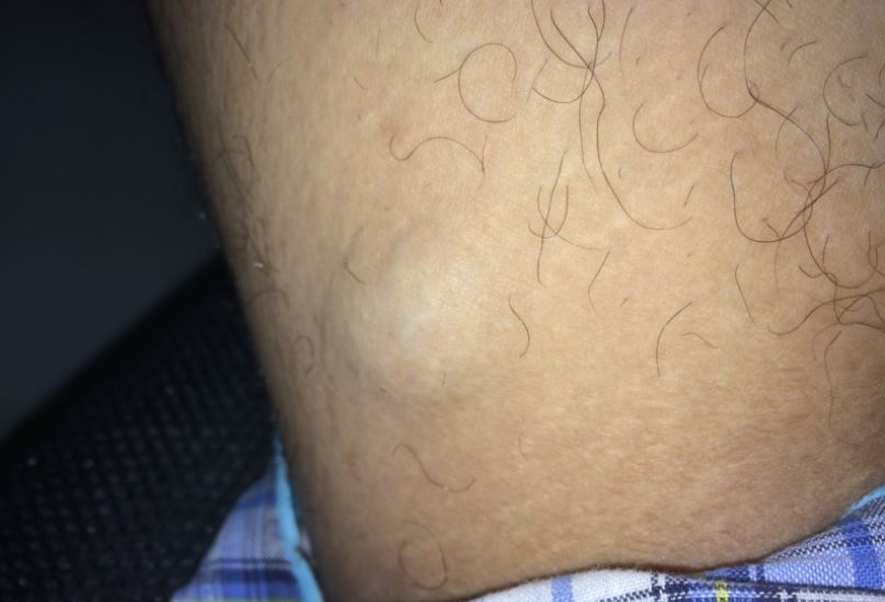 lump on inner thighs
