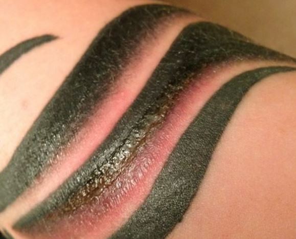 How do I tell my tattoo is infected - signs and symptoms