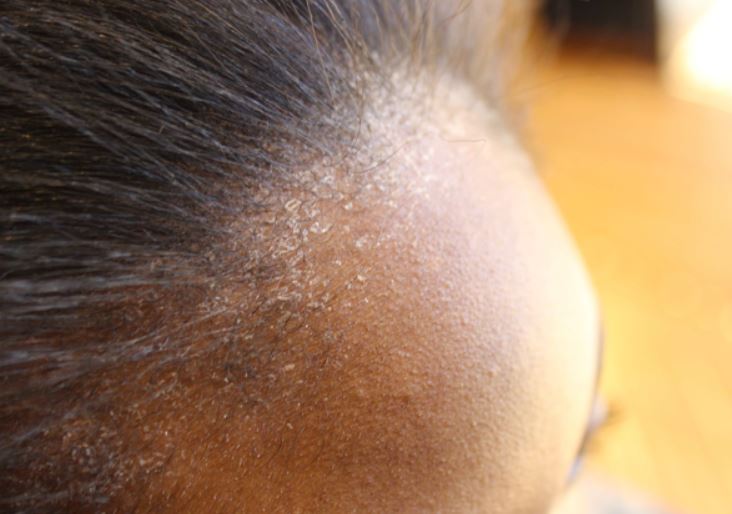 How to fix a dry scalp