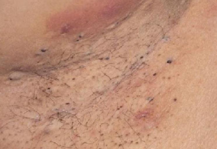 How to get rid of armpit blackheads
