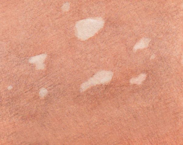 Idiopathic Guttate Hypomelanosis