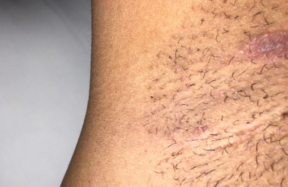 Itchy armpits