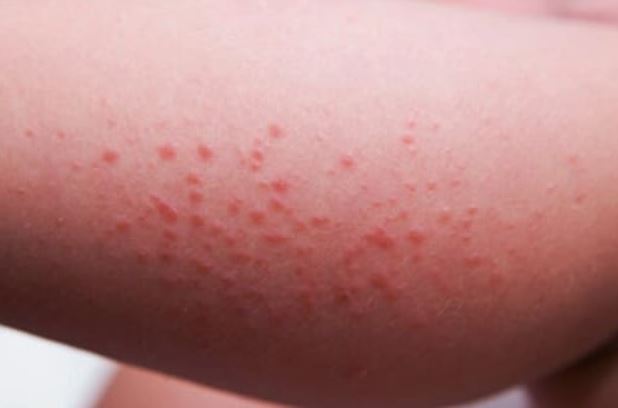 Raised red spots or dots on legs