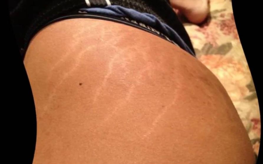 Stretch marks on hips causes