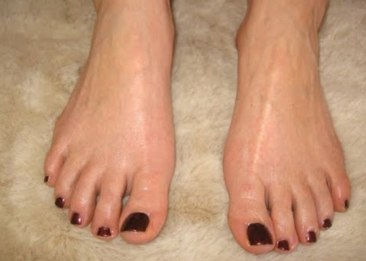Sweaty feet
