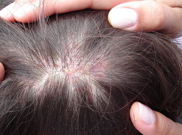 Why is my scalp inflamed