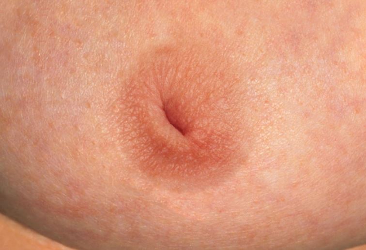 Inverted nipple