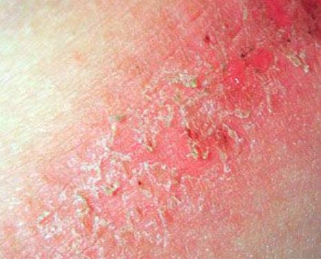 Skin chafing rash