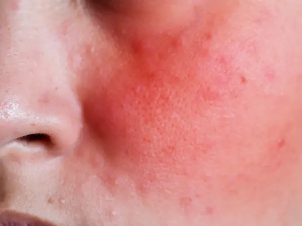 FLUSHED-RED-CHEEKS