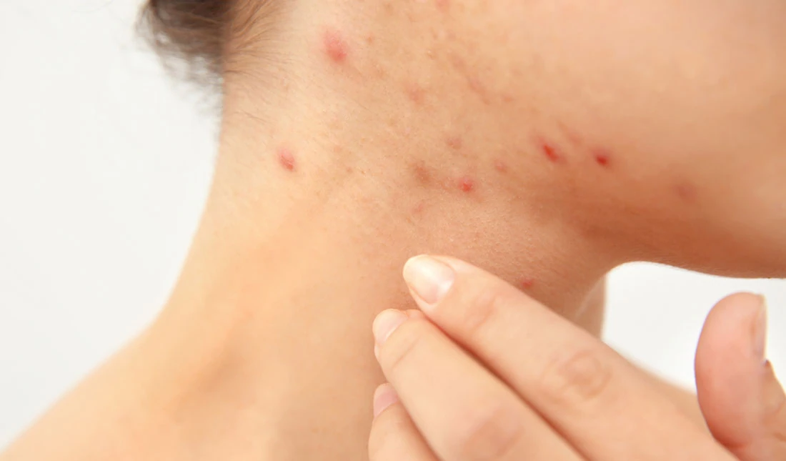 acne-on-neck