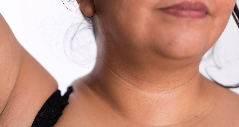 Neck Wrinkles